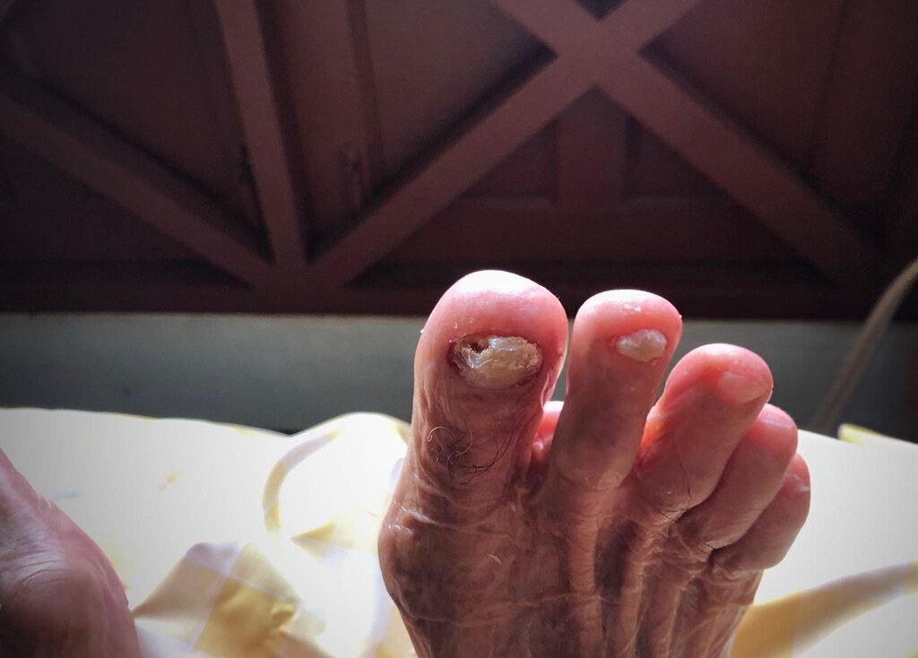 diabetic toenail
